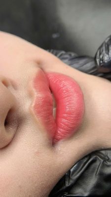 khử thâm môi bằng laser